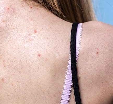 dream meaning of pimples on back